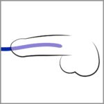 silicone dilator set - galeria 2